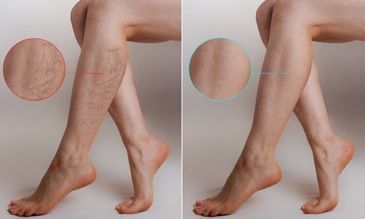 شوک بزرگ برای مبتلایان به واریس! درمان واریسی که پزشکان را شگفت زده کرد
