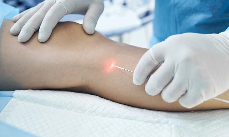 شوک بزرگ برای مبتلایان به واریس! درمان واریسی که پزشکان را شگفت زده کرد