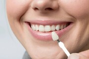 بهترین روش برای زیبایی دندان‌ها به توصیه دندانپزشکان