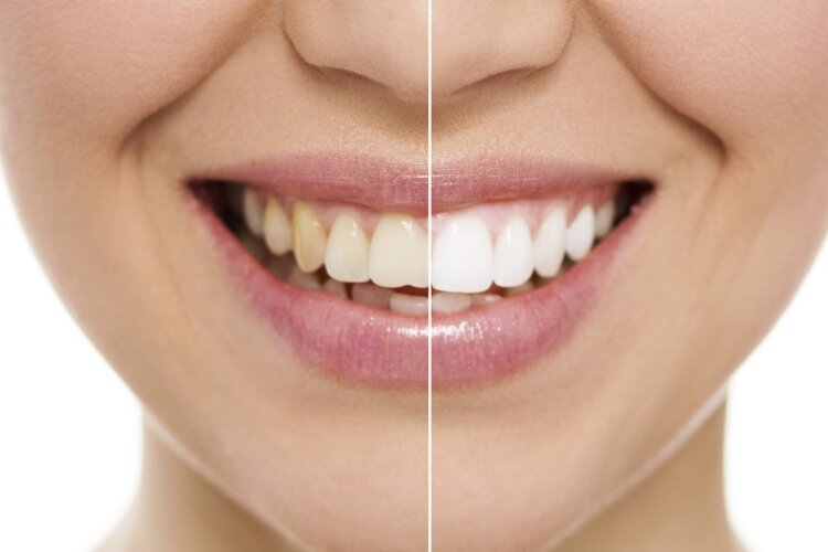 بهترین روش برای زیبایی دندانها به توصیه دندانپزشکان