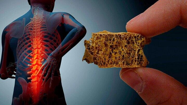 پوکی استخوان ،عوامل ایجاد آن تا پیشگیری پوکی استخوان ،عوامل ایجاد آن تا پیشگیری