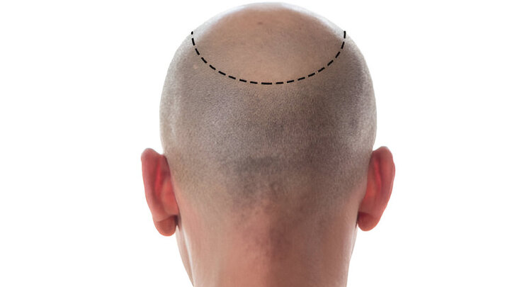 عوارض کاشت مو و خطراتی که شما نمی‌دانید + راه‌های پیشگیری