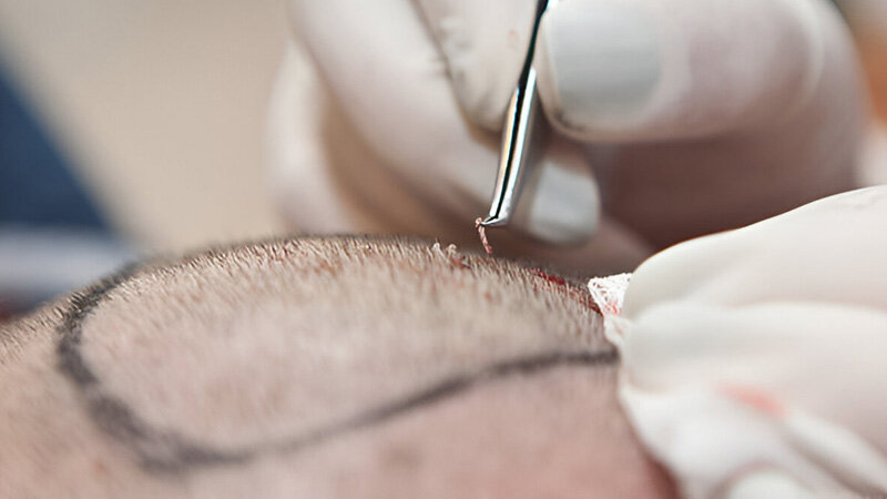 راهکارهای کاهش عوارض کاشت مو