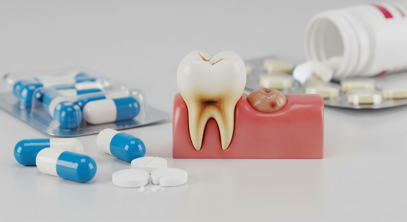 نکات بسیار مهم برای مصرف داروی عفونتی دندان