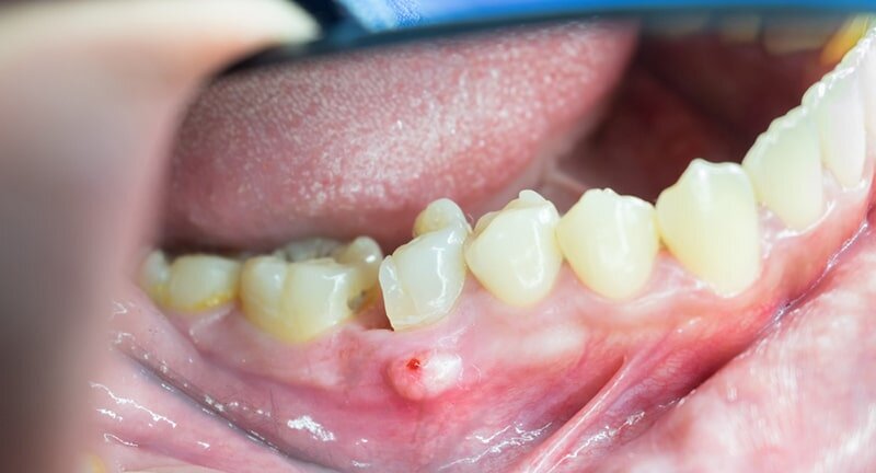 چه مدت باید برای عفونت متوسط (آبسه دندانی یا درگیری پالپ) قرص خورد؟