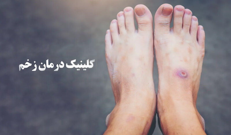 درمان زخم دیابتی