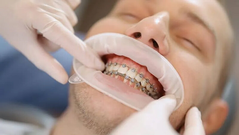 مدت زمان ارتودنسی در 40 سالگی