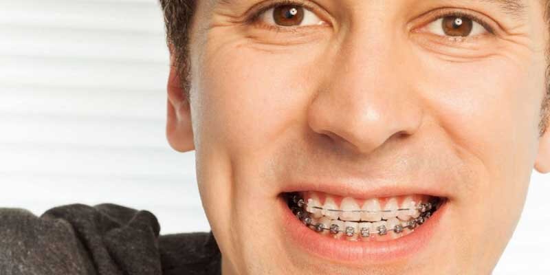 ارتودنسی در 40 سالگی، آری یا خیر؟ ارتودنسی در 40 سالگی، آری یا خیر؟