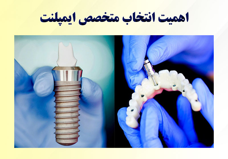 متخصص ایمپلنت