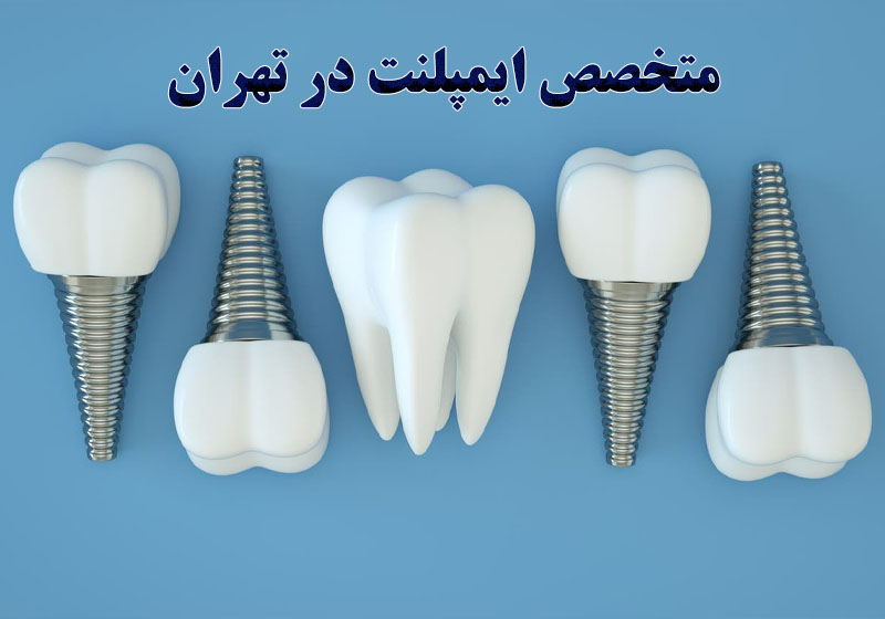 متخصص ایمپلنت در تهران