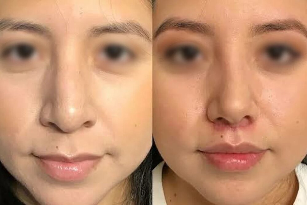 قبل و بعد عمل بینی با لیفت لب همزمان