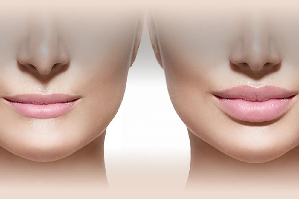 عمل همزمان بینی و لیفت لب