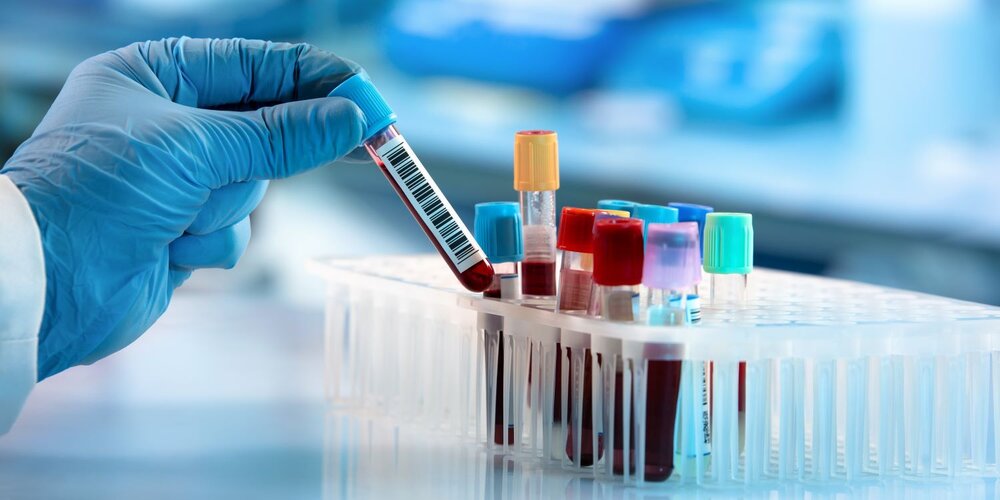 پایین بودن rdw cv در آزمایش خون به این معناست که سلولهای قرمز خون شما بسیار یکنواخت هستند