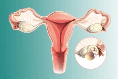 افزایش اضطراب و افسردگی در زنان مبتلا به سندرم تخمدان پلیکیستیک (PCOS) افزایش اضطراب و افسردگی در زنان مبتلا به سندرم تخمدان پلیکیستیک (PCOS)