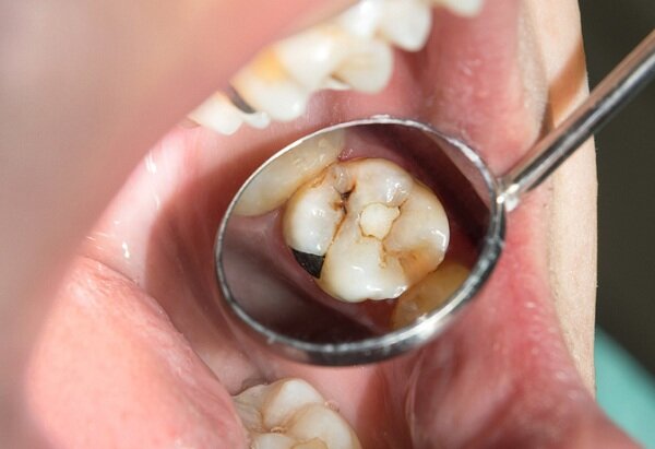 پوسیدگی دندان «مسری» است