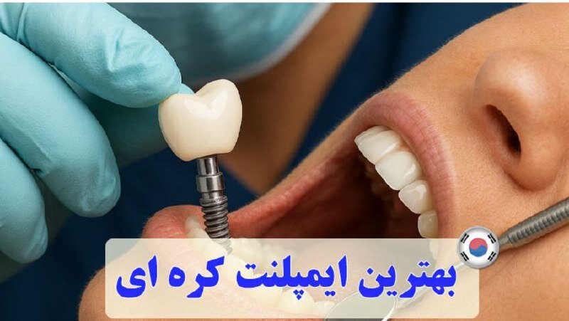 بهترین ایمپلنت کره‌ای