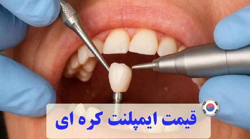 قیمت ایمپلنت کره‌ای