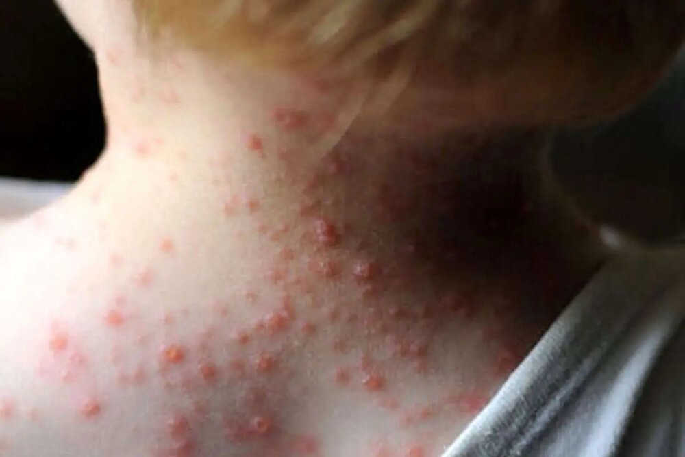 ضرورت تقویت واکسیناسیون با ثبت موارد سرخک در شمال کشور