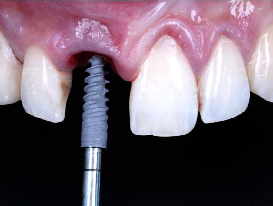 ایمپلنت فوری چیست؟ مزایا و معایب کاشت دندان یک روزه