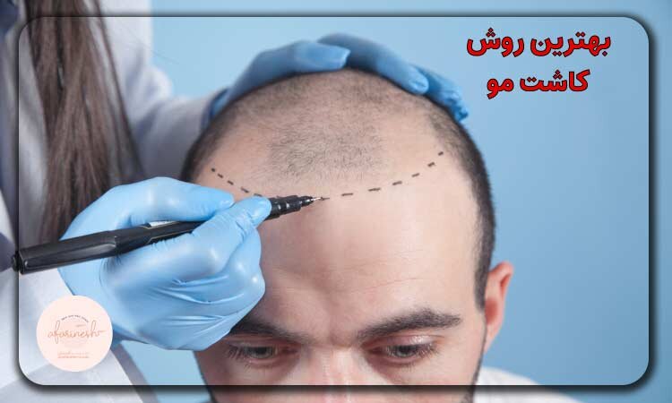 بهترین روش‌های کاشت مو در ایران؛ مزایا، معایب و نکات کلیدی پیش از اقدام