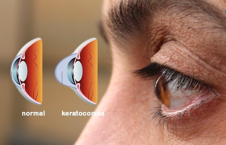 تشخیص بیماران پرخطر قوز قرنیه با الگوریتم هوش مصنوعی