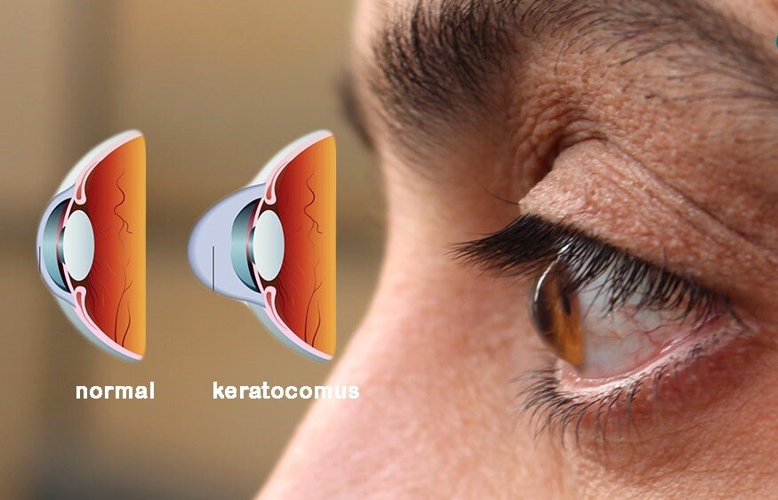 تشخیص بیماران پرخطر قوز قرنیه با الگوریتم هوش مصنوعی