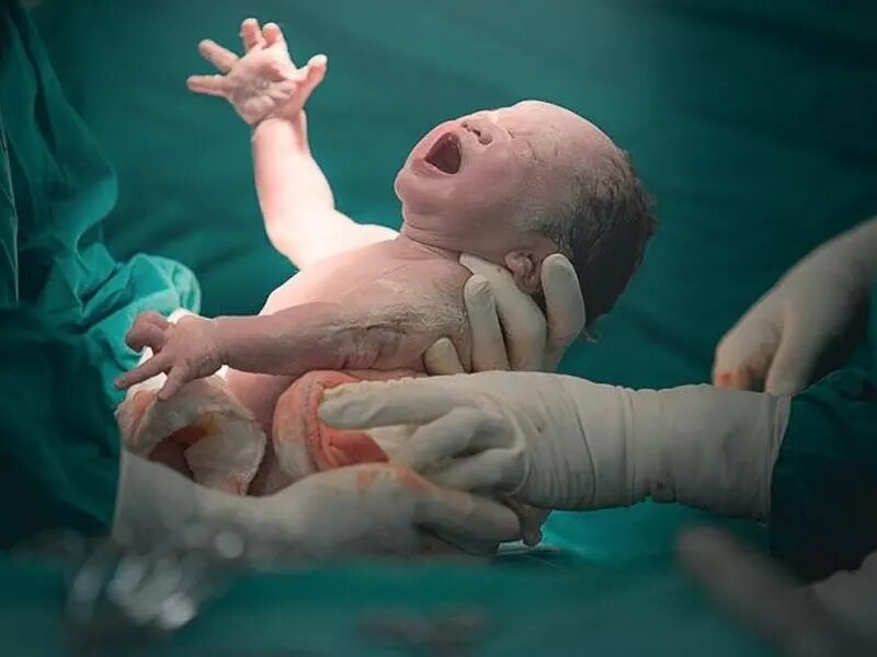 گیلان رکورددار سزارین در کشور؛ ۷۹ درصد زایمان‌ها غیرطبیعی انجام می‌شود