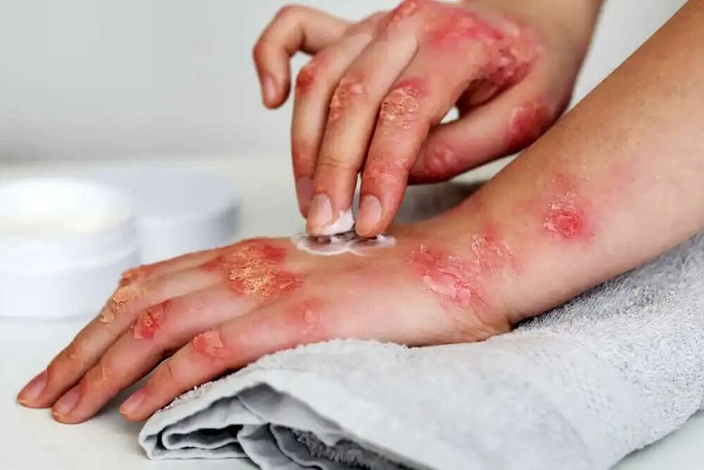 گیلان در رتبه سوم تا پنجم شیوع بیماری سل در کشور