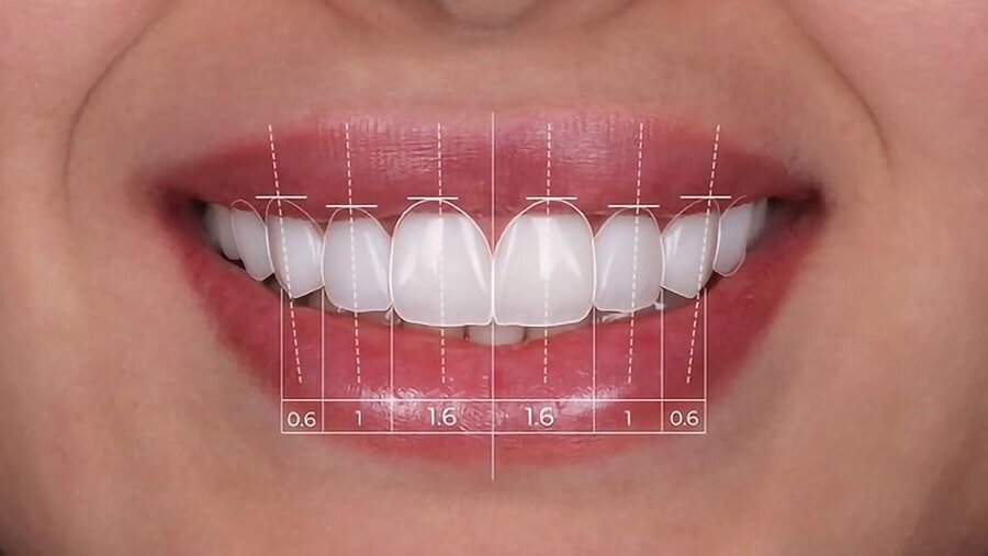 لمینت دندان