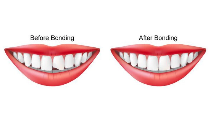 باندینگ دندان چیست؟
