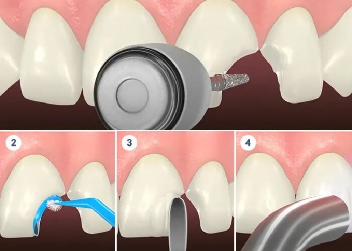 مراحل باندینگ دندان