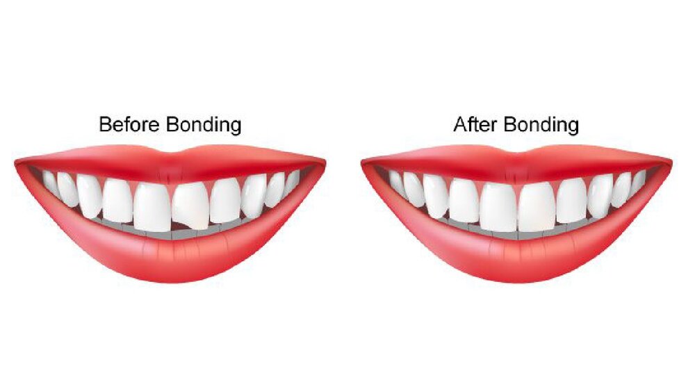 باندینگ دندان چیست؟