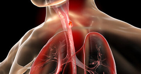مصرف چای داغ عامل ابتلا به سرطان مری در گیلان