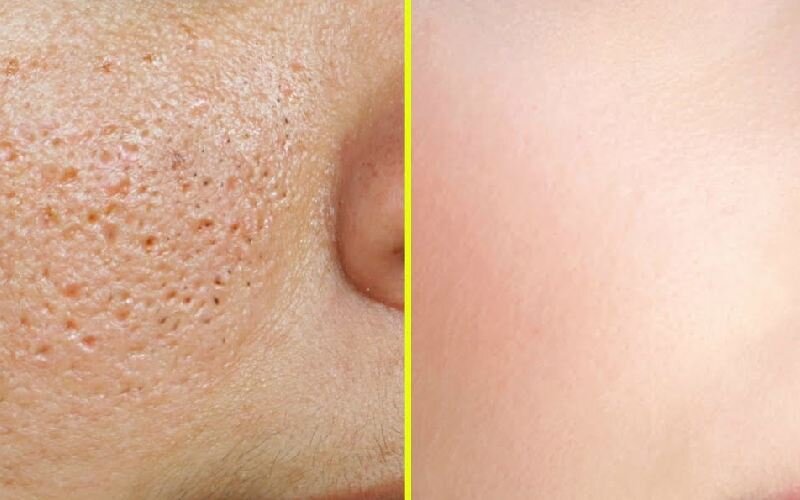 بهترین روش درمان منافذ باز پوست