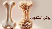 ۸۰ درصد مبتلایان به پوکی استخوان از بیماری خود اطلاع ندارند