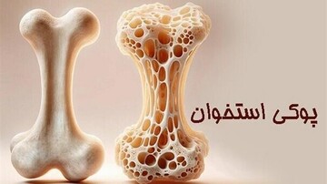 ۸۰ درصد مبتلایان به پوکی استخوان از بیماری خود اطلاع ندارند