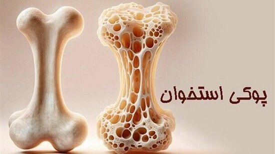 پوکی استخوان؛ تشخیص و درمان به‌ موقع