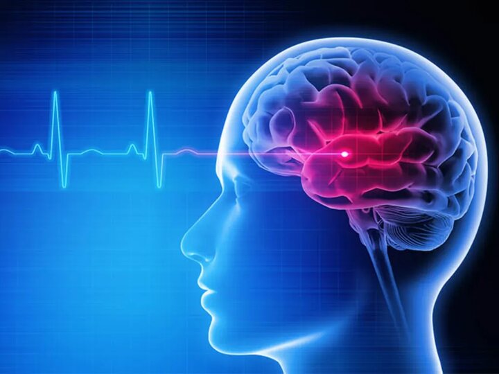 نجات در دقایق طلایی؛ تأکید بر شناخت علائم سکته مغزی در روز جهانی استروک