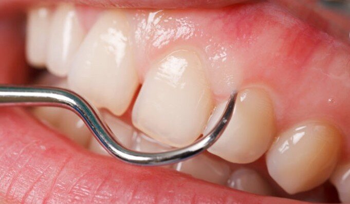 سلامت دهان، سپر محافظ مغز در برابر سکته