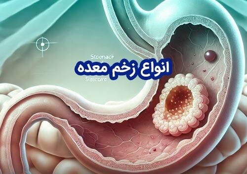 انواع زخم معده: علل، تشخیص و راهکارهای درمانی