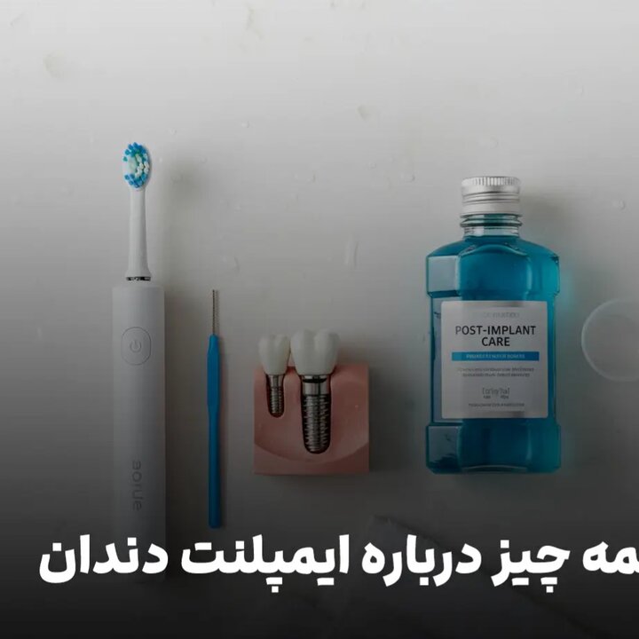 همه چیز درباره ایمپلنت دندان