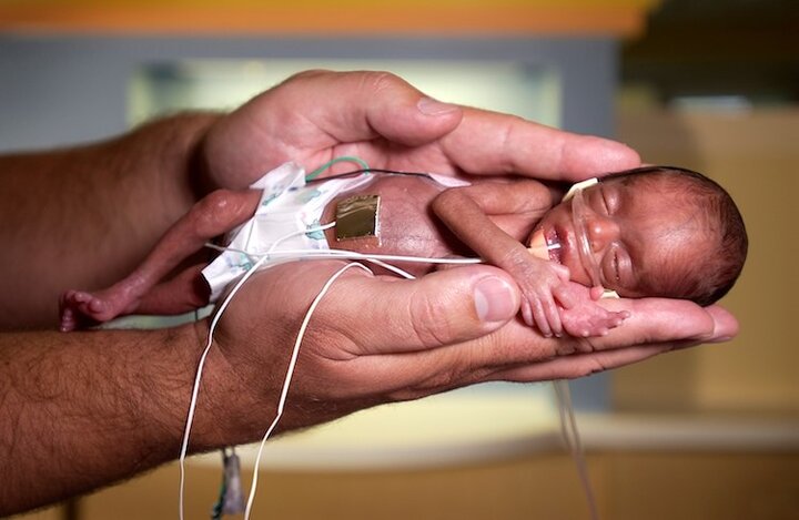 افزایش تولد نوزادان نارس در گیلان؛ زنگ خطر سلامت نسل آینده