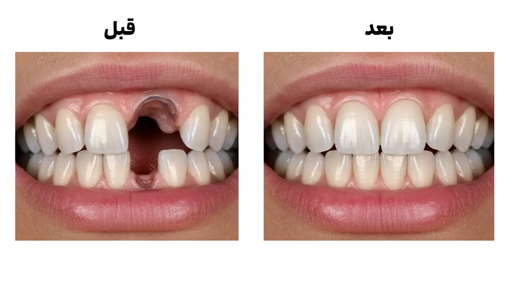 قبل و بعد ایمپلنت