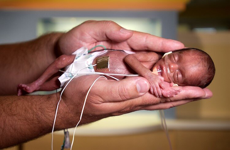 افزایش تولد نوزادان نارس در گیلان؛ زنگ خطر سلامت نسل آینده