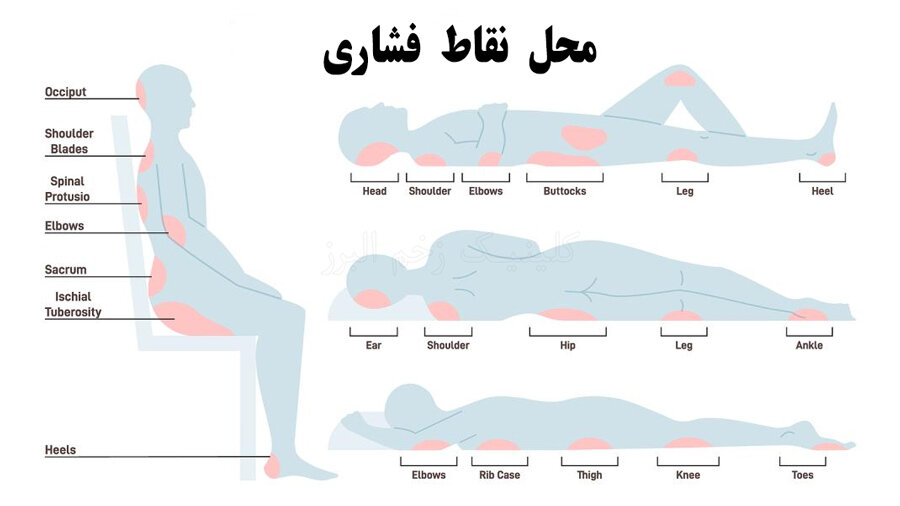 درمان زخم فشاری به سبک پرستاران حرفه‌ ای