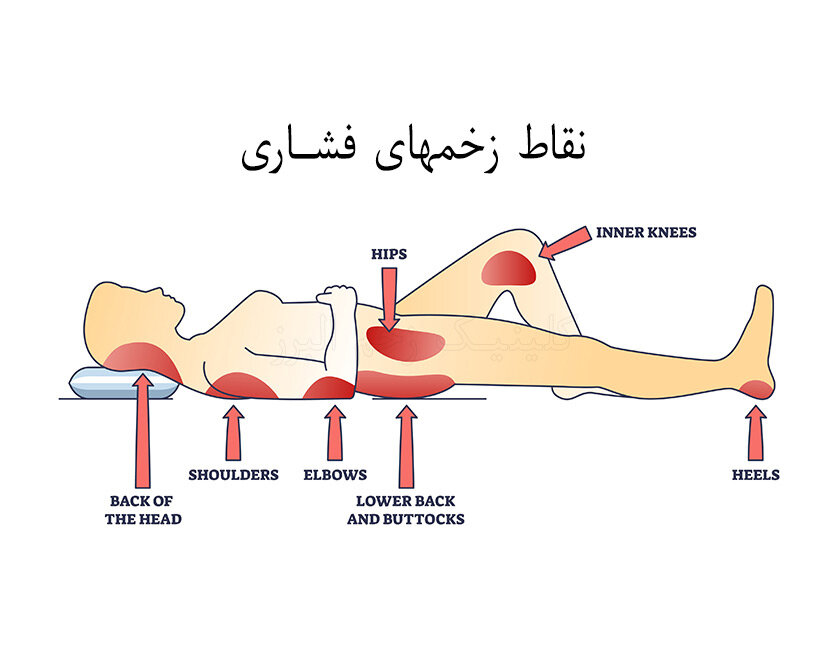 درمان زخم فشاری به سبک پرستاران حرفه‌ ای