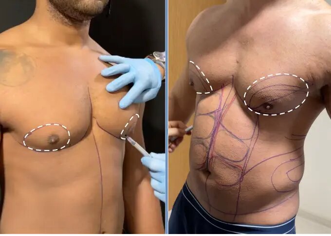 تفاوت ژنیکوماستی و چاقی سینه چیست؟