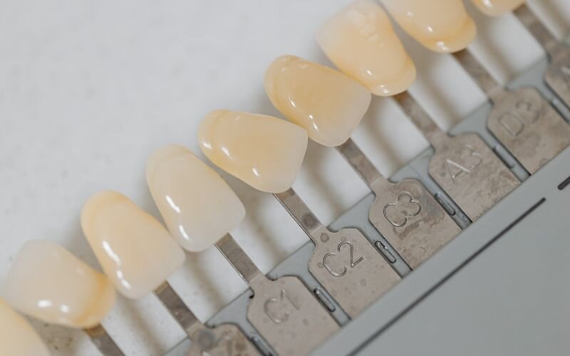 علت حساس شدن دندان بعد از کامپوزیت و روش های پیشگیری از آن