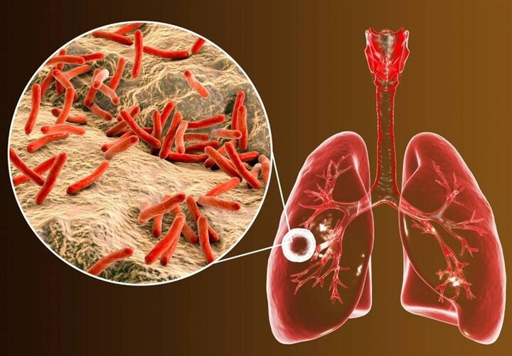 سل همچنان مرگبارترین بیماری عفونی جهان