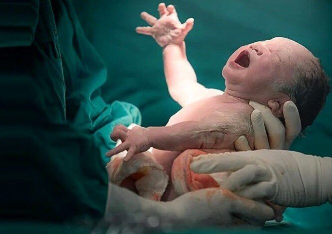 نجات نوزاد ۱۱روزه در جراحی حساس شکم در مرکز ۱۷ شهریور رشت